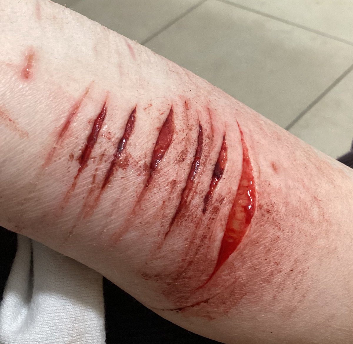 Found the pics of my first beans on my old phone and the scars are all so faded now(
#beanstwt #shtwt