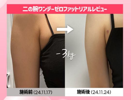 YOURCLINICJP's tweet photo. たった1回で瘦せられる⁉#ベンスクリニック の #ワンデーゼロファット は1回で部分痩せが可能❣️
超強力 #脂肪溶解注射 で夏に向けて体型管理🤍#ホンデ #江南 #明洞 #釜山 #COEX #狎鴎亭 

1部位(両側)4.9万₩
リジュラン2㏄ 初回9.9万₩

RT&amp;フォローで4月以降も適用可能✨

#渡韓 #韓国美容 https://t.co/BZCMdy41XS