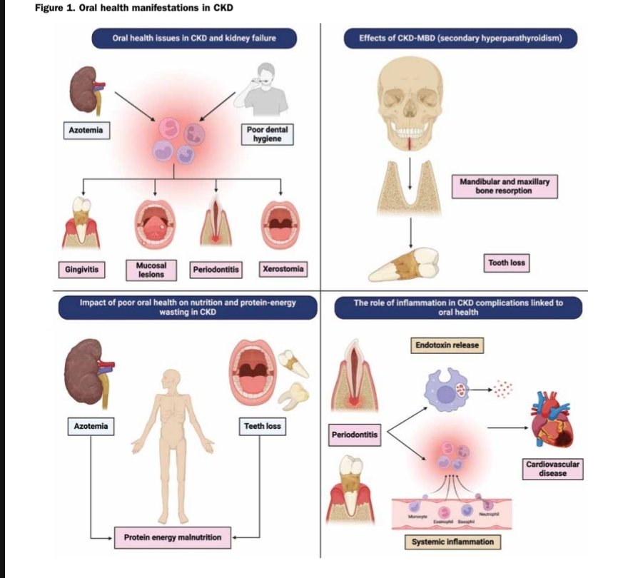 Intissar HADDIYA (@haddiyaintissar) on Twitter photo Close connection between #Oral_Health & chronic kidney disease (#CKD): xerostomia, candidiasis, gingival inflammation, & dental erosion, are due to uremia-related metabolic, immune, & hormonal imbalances. <a href="/AfricanAFRAN/">African Association of Nephrology (AFRAN)</a>
<a href="/ISNeducation/">ISN Education</a> <a href="/ISNkidneycare/">Int Society of Nephrology</a>
lnkd.in/e7ybE3qG Close connection between #Oral_Health & chronic kidney disease (#CKD): xerostomia, candidiasis, gingival inflammation, & dental erosion, are due to uremia-related metabolic, immune, & hormonal imbalances. <a href="/AfricanAFRAN/">African Association of Nephrology (AFRAN)</a>
<a href="/ISNeducation/">ISN Education</a> <a href="/ISNkidneycare/">Int Society of Nephrology</a>
lnkd.in/e7ybE3qG