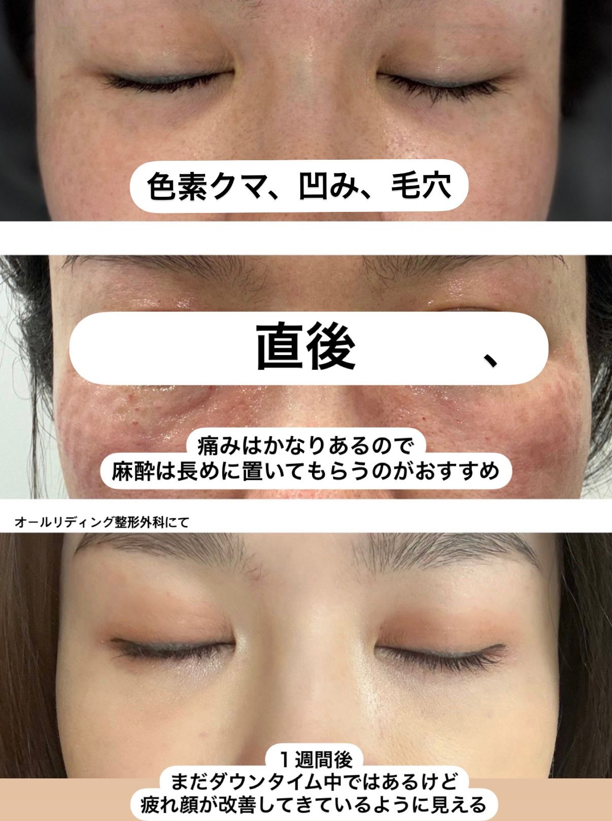韓国整形・*☽オールリティング整形外科 (@alllitingpsjpn) / X
