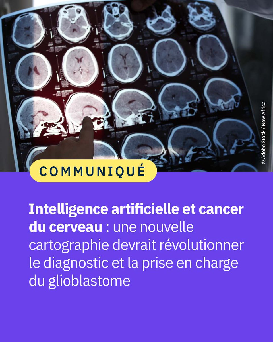 #Communiqué 🗞️  Des scientifiques ont identifié et cartographié différentes formes de glioblastome, une tumeur cérébrale agressive, en analysant les régulateurs génétiques. Une avancée vers des traitements plus ciblés. 🧠 🧬

👉 cnrs.fr/fr/presse/inte…
