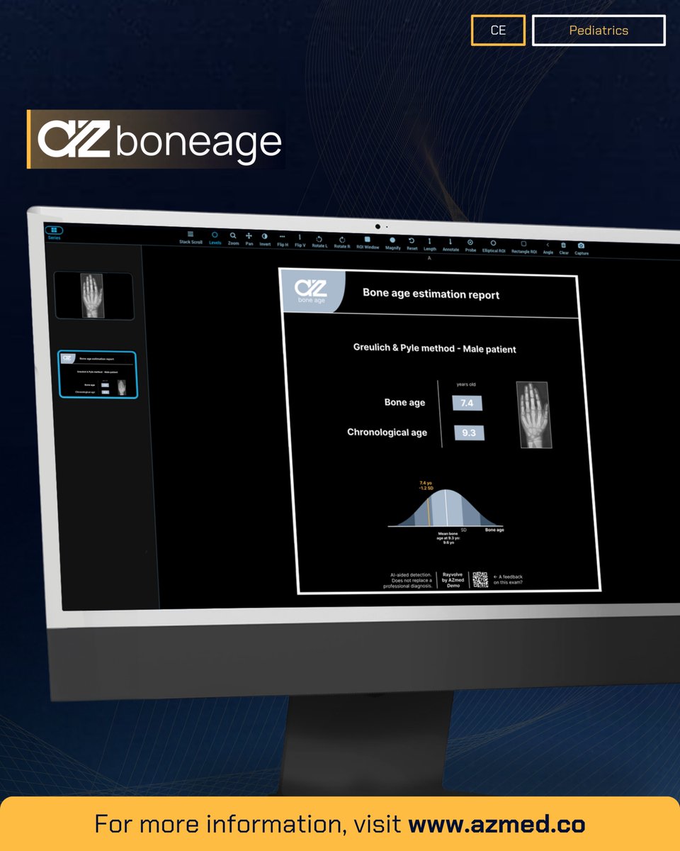 AZmed_AI's tweet image. Bone age estimation is essential in pediatric radiology but remains time-consuming.
AZboneage, a CE-marked AI solution from AZmed, delivers skeletal maturity assessment using the Greulich and Pyle method. It generates structured reports while preserving the original radiograph,…