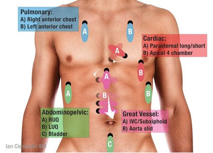Trauma Surgery & Acute Care Open (TSACO) (@tsaco_aast) on Twitter photo How can we better and more quickly assess surgical patients? <a href="/TCCACS/">Mattox/Vegas TCCACS</a> #TCCACS2025
"Invasive and non-invasive monitoring in the ICU"
➡️ bit.ly/4lKMUor
"Hocus pocus: advanced point-of-care ultrasound from the trauma bay to the surgical ICU"
➡️ bit.ly/4k7ZnRF How can we better and more quickly assess surgical patients? <a href="/TCCACS/">Mattox/Vegas TCCACS</a> #TCCACS2025
"Invasive and non-invasive monitoring in the ICU"
➡️ bit.ly/4lKMUor
"Hocus pocus: advanced point-of-care ultrasound from the trauma bay to the surgical ICU"
➡️ bit.ly/4k7ZnRF