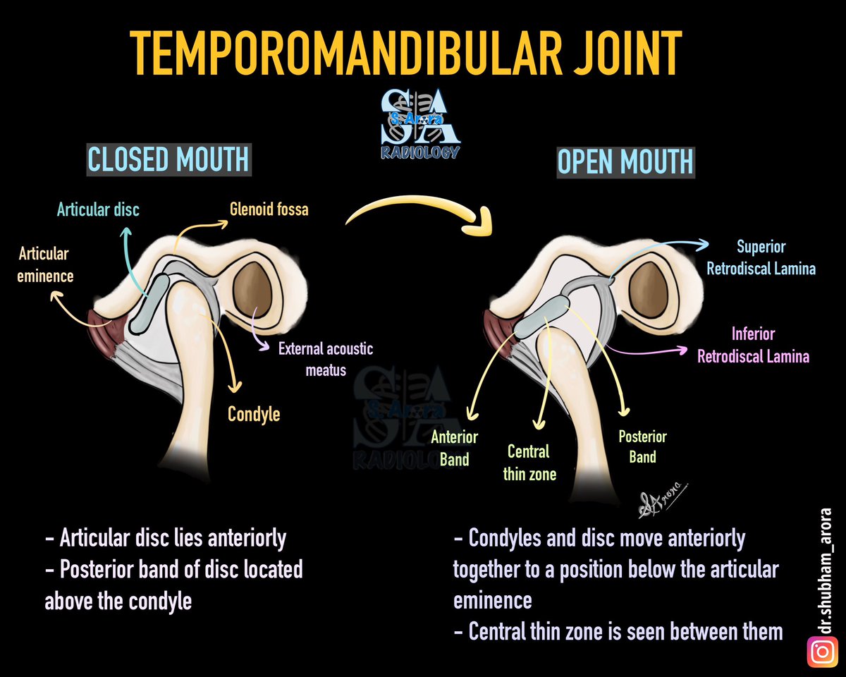Dr_S_Arora's tweet image. Slide on anatomy of temporomandibular joint.
#radiology #Medx