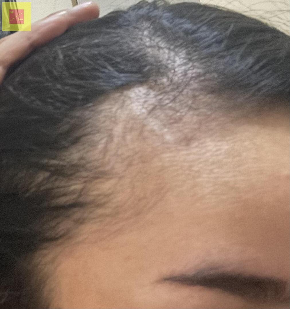 Gais apa ada yg rambutnya petak diatas umur 18! Ya? Alias pas udah hampir 1/4 abad rambutnya pada pitak itu normal ga si? Malu bgt aku apalagi rambut bagian depan, gimana ya caranya nunbuhin biar badai, perasaan rontoknya dikit tapi tiba2 pas ngaca pitak😭