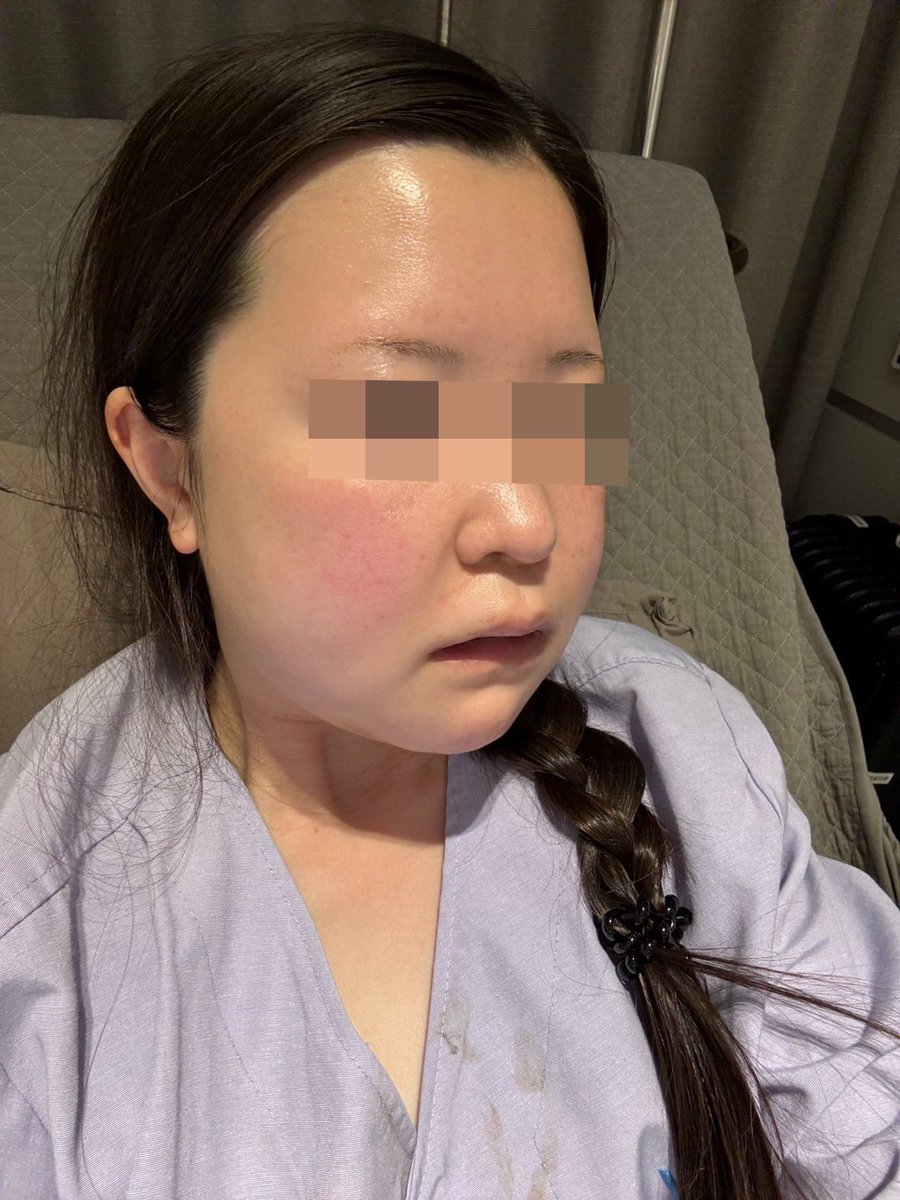 rmk7198's tweet photo. 〈手術3日目〉
今日が退院です。ホテルのチェックインに合わせて退院時間もずらして貰ったりで最後まで本当にお世話になりました。昨日よりも顔の腫れが酷くなりましたが、これから腫れが引いてくるのが楽しみです。 https://t.co/JL3UcCCAYj
