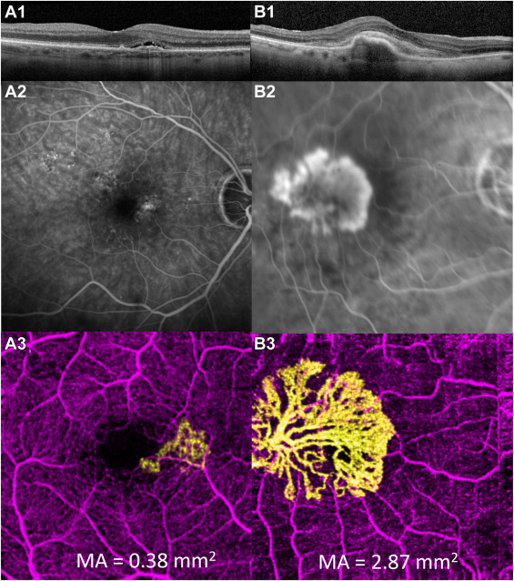 Michael F. Chiang, MD (@neidirector) on Twitter photo AI algorithm combines 3D structural OCT and en face OCTA simultaneously to improve accuracy of macular neovascularization segmentation and detection.
#NEIfunded <a href="/CaseyEye/">OHSU Casey Eye</a> <a href="/MahidolU/">Mahidol University</a> <a href="/SirirajMedicine/">Faculty of Medicine Siriraj Hospital, Mahidol U.</a> <a href="/YaliJiaOCT/">Yali Jia</a>
@AAOJournal: doi.org/10.1016/j.oret… AI algorithm combines 3D structural OCT and en face OCTA simultaneously to improve accuracy of macular neovascularization segmentation and detection.
#NEIfunded <a href="/CaseyEye/">OHSU Casey Eye</a> <a href="/MahidolU/">Mahidol University</a> <a href="/SirirajMedicine/">Faculty of Medicine Siriraj Hospital, Mahidol U.</a> <a href="/YaliJiaOCT/">Yali Jia</a>
@AAOJournal: doi.org/10.1016/j.oret…