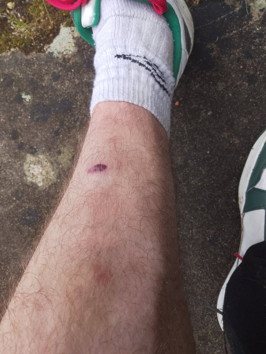 Alors j'étais en train de fendre du bois avec une grosse masse et un gros coin en ferraille quand celui-ci a ripé et est venu se planter dans mon tibia, c'est grave docteur ?