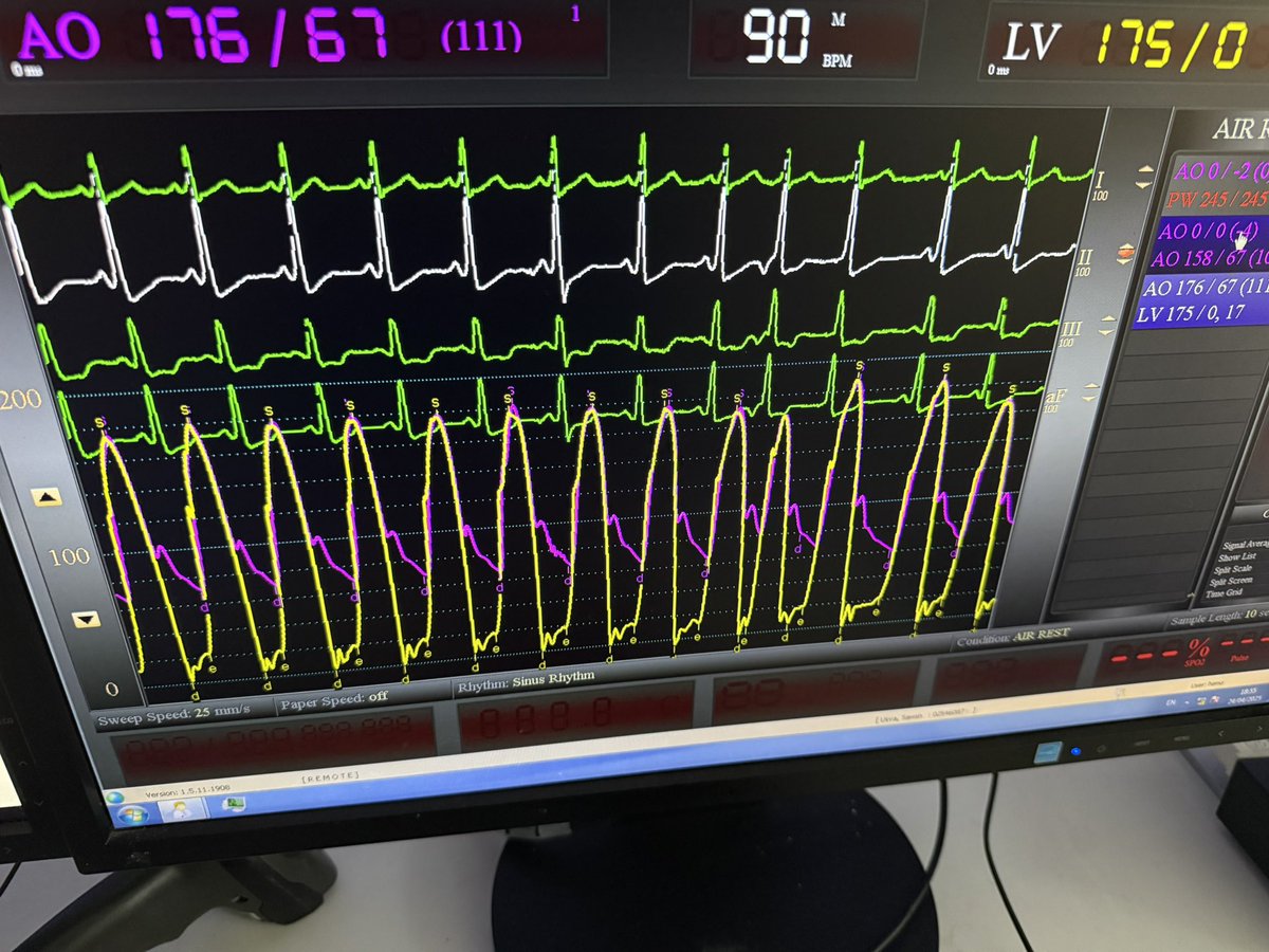 Hazim Rahbi (@hrahbi) on Twitter photo This is what we get with 23mm S3UR.
Hopefully more of these excellent results with resilia Gulf registry. Excellent collaboration with many centers in Saudi Arabia, Kuwait and Abu Dhabi
<a href="/mirvatalasnag/">MIЯVΛƬ #IC</a> <a href="/DrAmirKaki/">Amir Kaki, MD</a> <a href="/MohammedQintar/">Mohammed Qintar, MD MSc</a> <a href="/MarwanSaadMD/">Marwan Saad, MD, PhD</a> <a href="/Dr_Mubarak_/">Mubarak Al Dossari</a> <a href="/GilbertTangMD/">Dr. Gilbert Tang</a> This is what we get with 23mm S3UR.
Hopefully more of these excellent results with resilia Gulf registry. Excellent collaboration with many centers in Saudi Arabia, Kuwait and Abu Dhabi
<a href="/mirvatalasnag/">MIЯVΛƬ #IC</a> <a href="/DrAmirKaki/">Amir Kaki, MD</a> <a href="/MohammedQintar/">Mohammed Qintar, MD MSc</a> <a href="/MarwanSaadMD/">Marwan Saad, MD, PhD</a> <a href="/Dr_Mubarak_/">Mubarak Al Dossari</a> <a href="/GilbertTangMD/">Dr. Gilbert Tang</a>