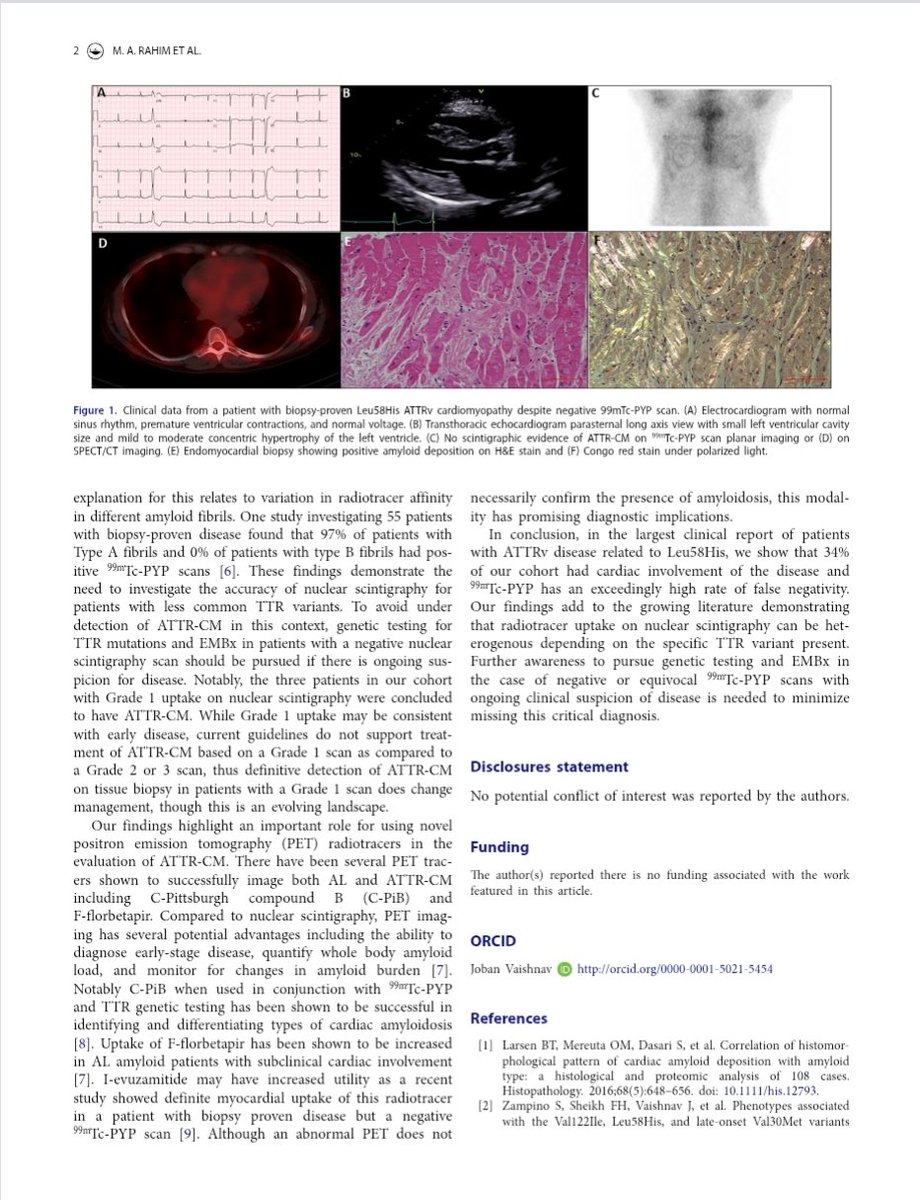 Critical data - while bone scintigraphy has resulted in a massive improvement in our diagnostic abilities in transthyretin amyloidosis, it remains insufficient with significant limitations. In this report, patients with L58H variant had closed to 90% false negative PYP scans. In