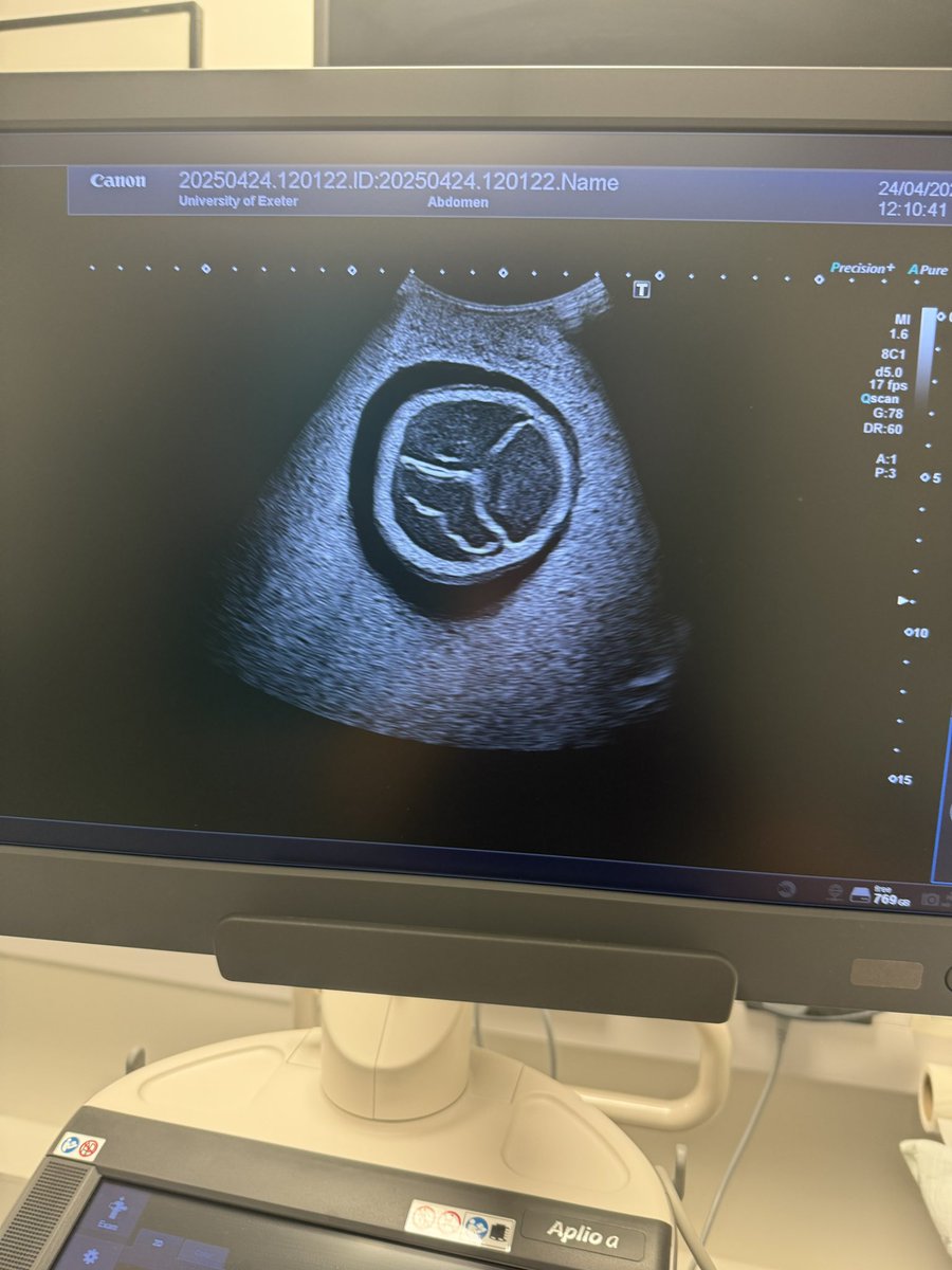 UoE Medical Imaging (@uoe_mi) on Twitter photo Getting the #Exeterscholars some hands on ultrasound experience. #outreach #futureradiographers <a href="/demelzajgreen/">Demelza Green</a> <a href="/ifraaxabdiosman/">Ifraax Abdi Osman</a> Getting the #Exeterscholars some hands on ultrasound experience. #outreach #futureradiographers <a href="/demelzajgreen/">Demelza Green</a> <a href="/ifraaxabdiosman/">Ifraax Abdi Osman</a>