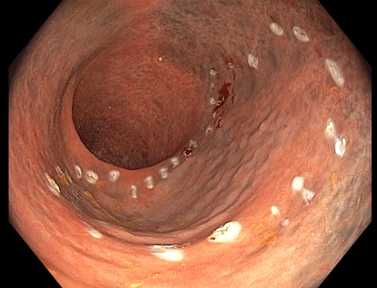 (Low grade) dysplasia in long standing ulcerative colitis might be difficult to delineate, especially after you start with the resection due to resection artifacts. 

Recommend margin marking prior to resection.