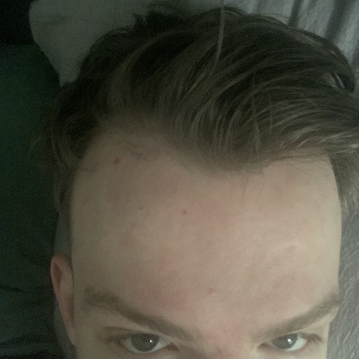 got the McDonald’s hairline and 20 nugget forehead combo