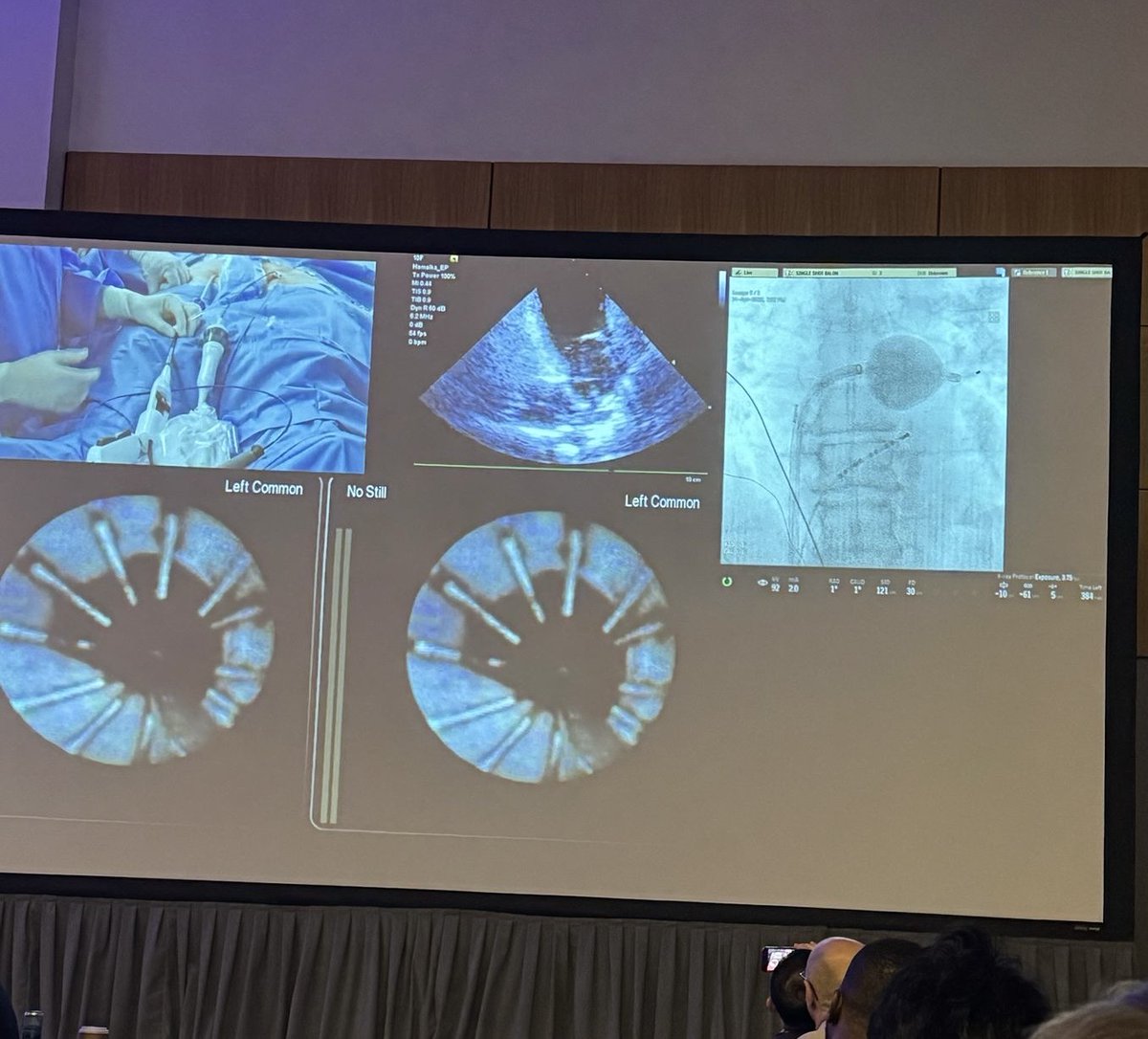 ⚡#HRS2025 week is off to a strong start! Catch the CardioFocus PFA highlights so far➡️

Note: The OptiShot™ PFA Balloon System is investigational and not approved for commercial use.