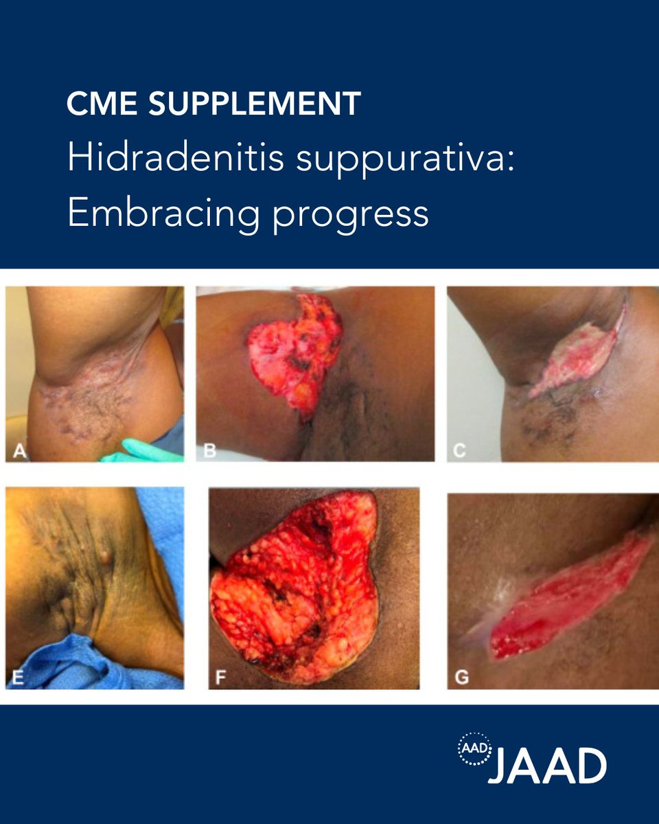 JAAD’s CME supplement on Hidradenitis Suppurativa offers 11 CME credits and valuable insights on HS care &amp; management. Read updates on therapies, epidemiology, earn CME and more: bit.ly/49D791O