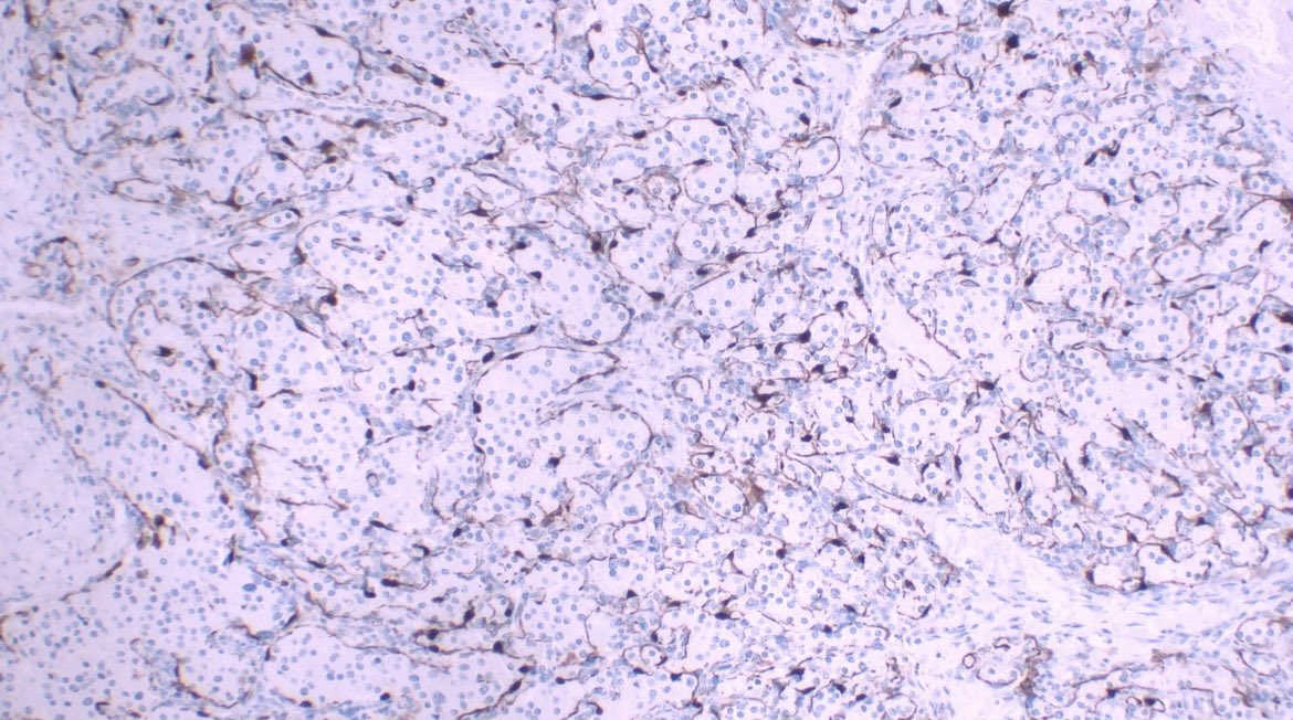 Paraganglioma

Cervical nodule

Epithelioid (but CK-) cells with eosinophilic cytoplasm, ovoid and salt and pepper nuclei, arranged in a nested pattern.

Neuroendocrine markers +
S100 +: sustentacular cells

#path #pathology