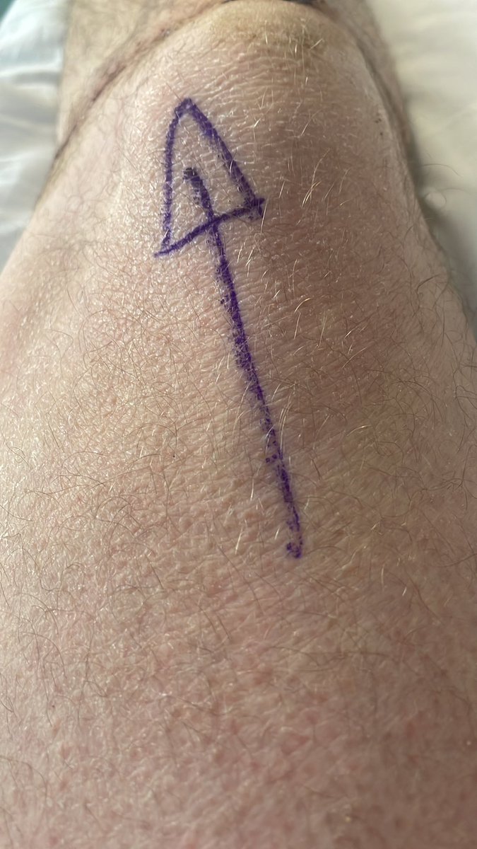 TheFrenchPaddy2's tweet photo. Woohoo operation tomorrow morning finally if no emergencies come in tonight #tibia #fibular #IlizarovApparatus #Operation #hospital https://t.co/rIJJaomyHO
