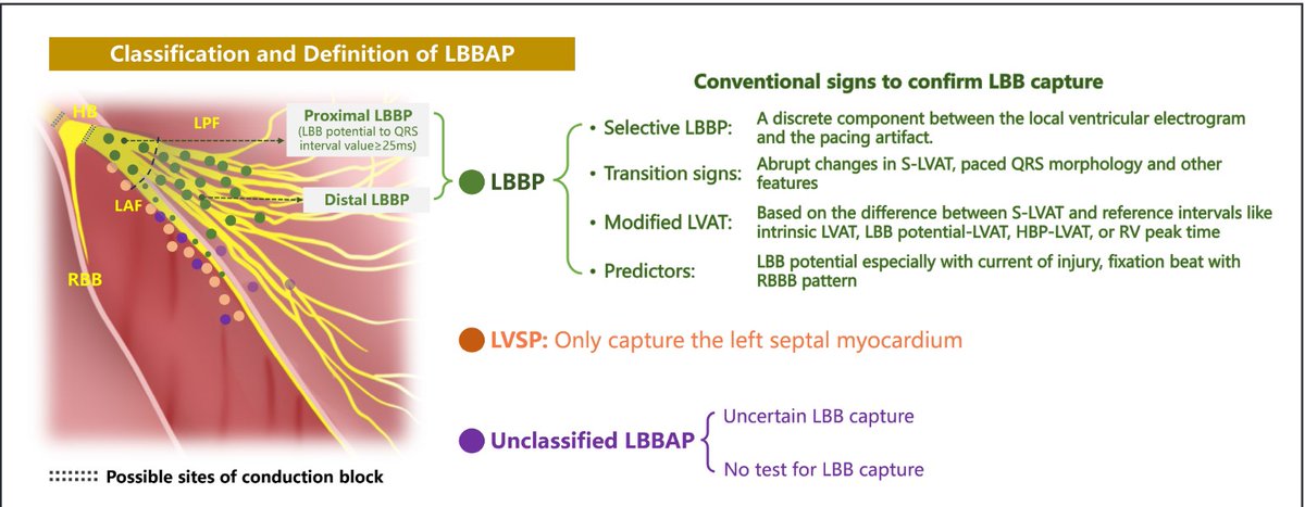 Circulation (@circaha) on Twitter photo Left bundle branch pacing (LBBP) restores physiologic conduction beyond traditional CRT limits. With better synchrony, broad applicability, and growing clinical support, LBBP is emerging as the future of cardiac pacing <a href="/MdHuang/">Weijian Huang</a>
ahajournals.org/doi/epub/10.11… Left bundle branch pacing (LBBP) restores physiologic conduction beyond traditional CRT limits. With better synchrony, broad applicability, and growing clinical support, LBBP is emerging as the future of cardiac pacing <a href="/MdHuang/">Weijian Huang</a>
ahajournals.org/doi/epub/10.11…