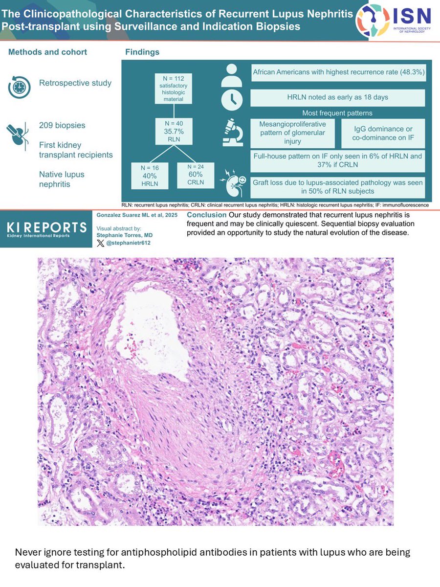 Priya Alexander, MD (@mpalexandermd) on Twitter photo Lupus nephritis (native) : classic immune thrombi, wire loop lesions & endocapillary cells++. Extra glomerular immune deposits : C1q( PTC/TBM staining). EM: “wire-loop” & PTC immune deposits.
Read our 📝 on lupus in TX. <a href="/MayoClinicPath/">Mayo Clinic Pathology</a> <a href="/MayoClinicNeph/">Mayo Clinic Nephrology</a> <a href="/MayoTransplant/">Mayo Clinic Transplant</a> <a href="/KIReports/">KIReports</a> Lupus nephritis (native) : classic immune thrombi, wire loop lesions & endocapillary cells++. Extra glomerular immune deposits : C1q( PTC/TBM staining). EM: “wire-loop” & PTC immune deposits.
Read our 📝 on lupus in TX. <a href="/MayoClinicPath/">Mayo Clinic Pathology</a> <a href="/MayoClinicNeph/">Mayo Clinic Nephrology</a> <a href="/MayoTransplant/">Mayo Clinic Transplant</a> <a href="/KIReports/">KIReports</a>