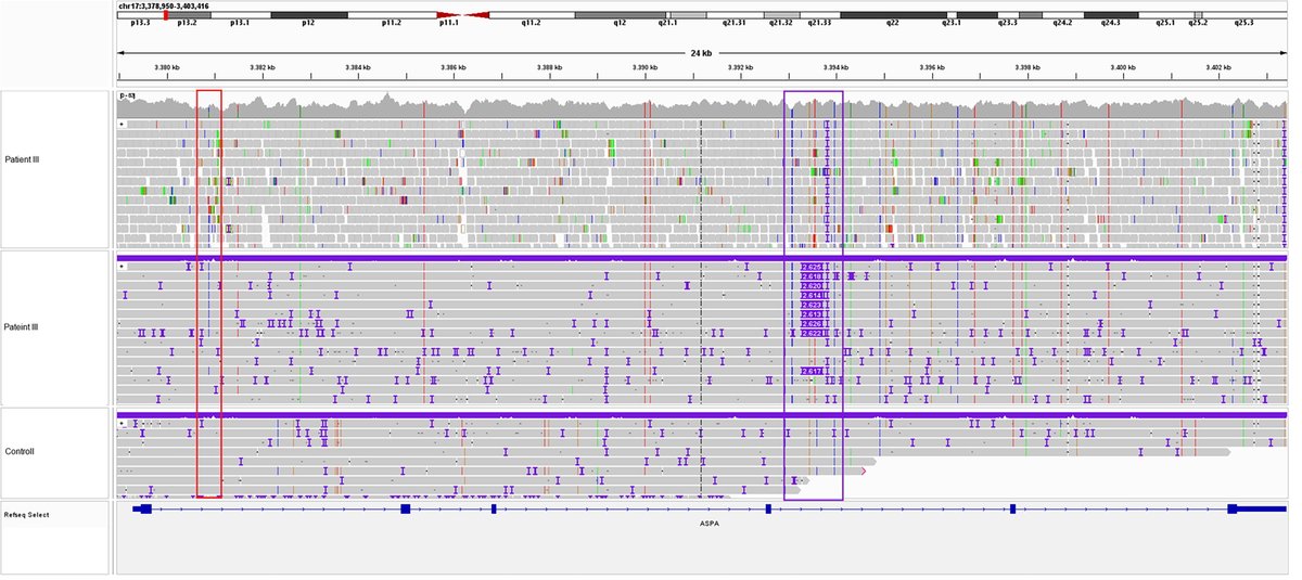 Identifying a Novel Factor in Canavan Disease Pathogenesis -- Read the Open Access article now: liebertpub.com/doi/10.1089/hu…
