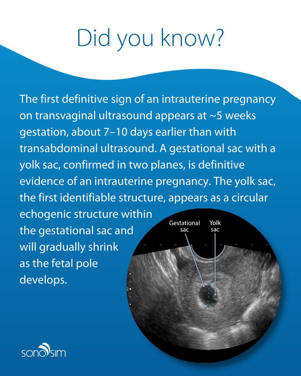 Ultrasound can detect an intrauterine pregnancy earlier than you might think! This tiny first sign is an important milestone in early pregnancy assessment. ⭐️

#obultrasound #sonosim #ultraoundtraining #obgyn #obgynultrasound