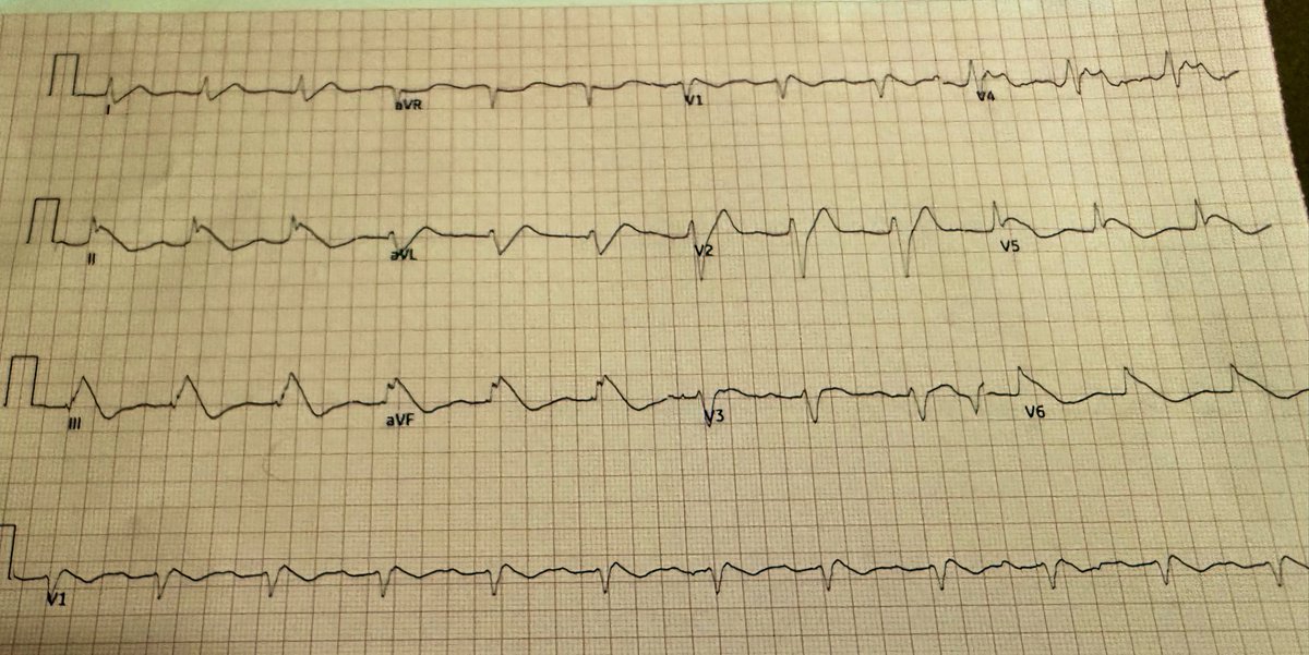 Tom Wilson (@twilsonmd) on Twitter photo 50s male, OOH arrest, Classic EKG for…ER doc wanted my input for STEMI.
<a href="/EM_RESUS/">Sam Ghali, M.D.</a> <a href="/DrRajeshG1/">Dr G Rajesh (Gopalan Nair Rajesh).</a> <a href="/AuroraCVFellows/">Aurora Cardiovascular Disease Fellowship</a> <a href="/MedResidences/">medresidences</a> <a href="/ShakyEKG_MD/">Yousif Al-Saiegh MD</a> <a href="/TheEKGGuy/">Anthony Kashou, MD</a> <a href="/uw_IMresidency/">UW IM Residency</a> <a href="/Erresidentsquad/">ERresidentsquad</a> 50s male, OOH arrest, Classic EKG for…ER doc wanted my input for STEMI.
<a href="/EM_RESUS/">Sam Ghali, M.D.</a> <a href="/DrRajeshG1/">Dr G Rajesh (Gopalan Nair Rajesh).</a> <a href="/AuroraCVFellows/">Aurora Cardiovascular Disease Fellowship</a> <a href="/MedResidences/">medresidences</a> <a href="/ShakyEKG_MD/">Yousif Al-Saiegh MD</a> <a href="/TheEKGGuy/">Anthony Kashou, MD</a> <a href="/uw_IMresidency/">UW IM Residency</a> <a href="/Erresidentsquad/">ERresidentsquad</a>