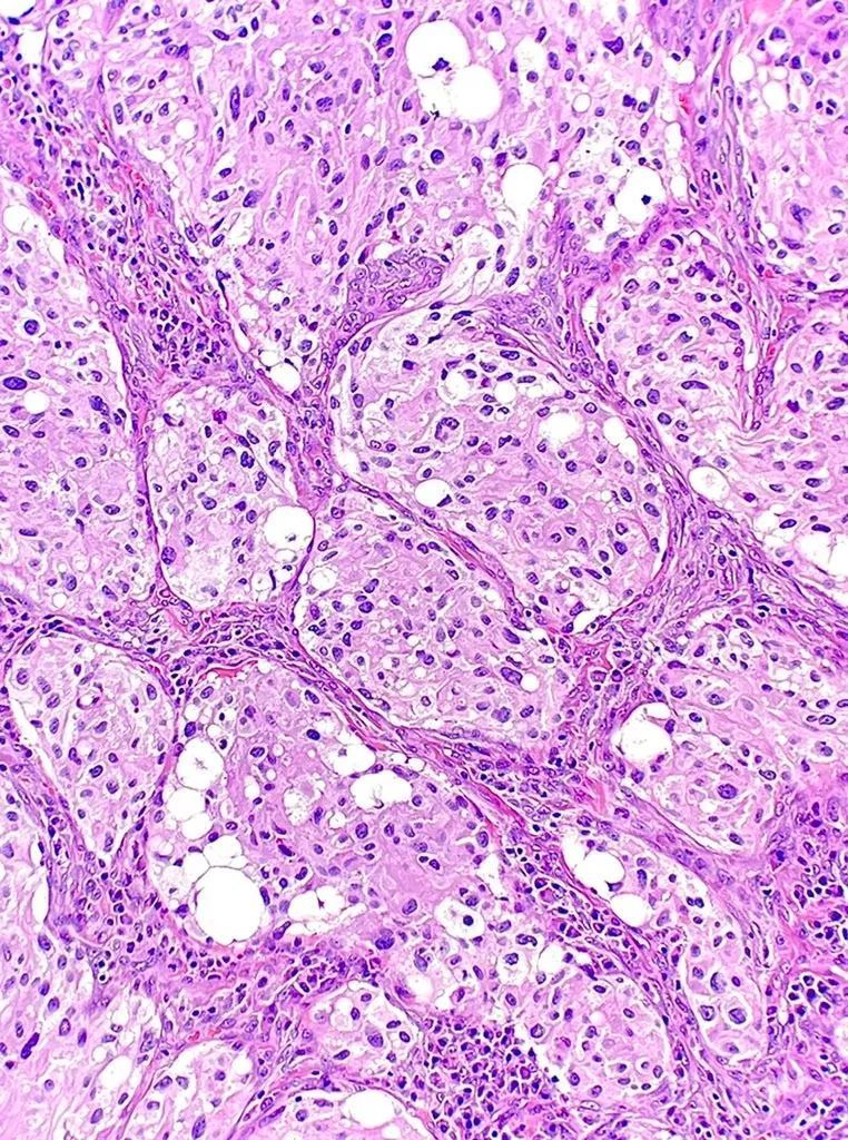 Excision of a mass from the parapharyngeal space reveals tumor cells arranged in an organoid (zelballen) pattern. What is the diagnosis? Answer: buff.ly/2hLDBy3 #PathArt #PathTwitter #MedTwitter
