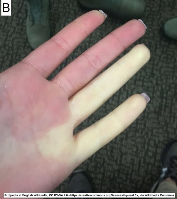 Path4People's tweet image. A distinction I had forgotten; they are somewhat similar but different

What is A, what is B?  

Both triggered by cold.  One has a &quot;white blue red&quot; skin change and brief.  The other has red bumps, itchiness and can lead to blisters, and last for weeks.

#pathx #fammed #dermpath