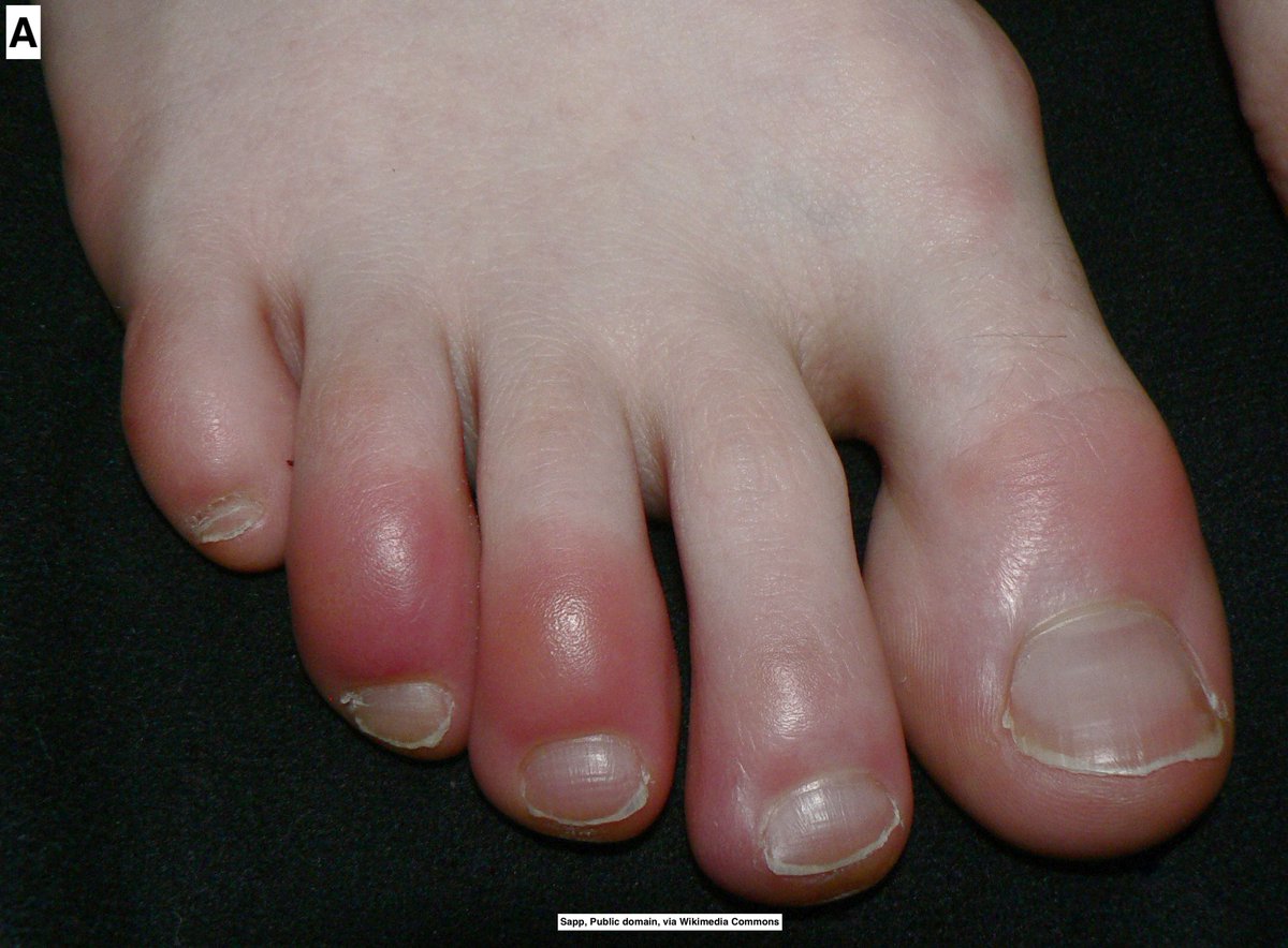 Path4People's tweet image. A distinction I had forgotten; they are somewhat similar but different

What is A, what is B?  

Both triggered by cold.  One has a &quot;white blue red&quot; skin change and brief.  The other has red bumps, itchiness and can lead to blisters, and last for weeks.

#pathx #fammed #dermpath