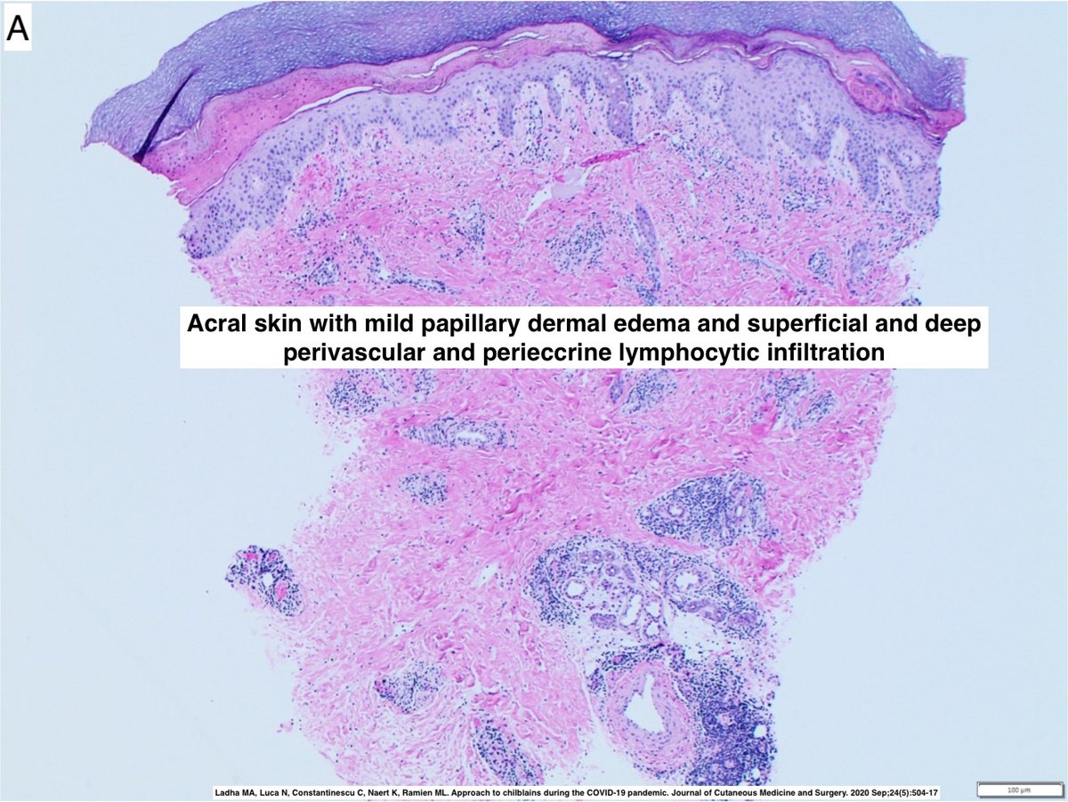 Path4People's tweet image. A distinction I had forgotten; they are somewhat similar but different

What is A, what is B?  

Both triggered by cold.  One has a &quot;white blue red&quot; skin change and brief.  The other has red bumps, itchiness and can lead to blisters, and last for weeks.

#pathx #fammed #dermpath