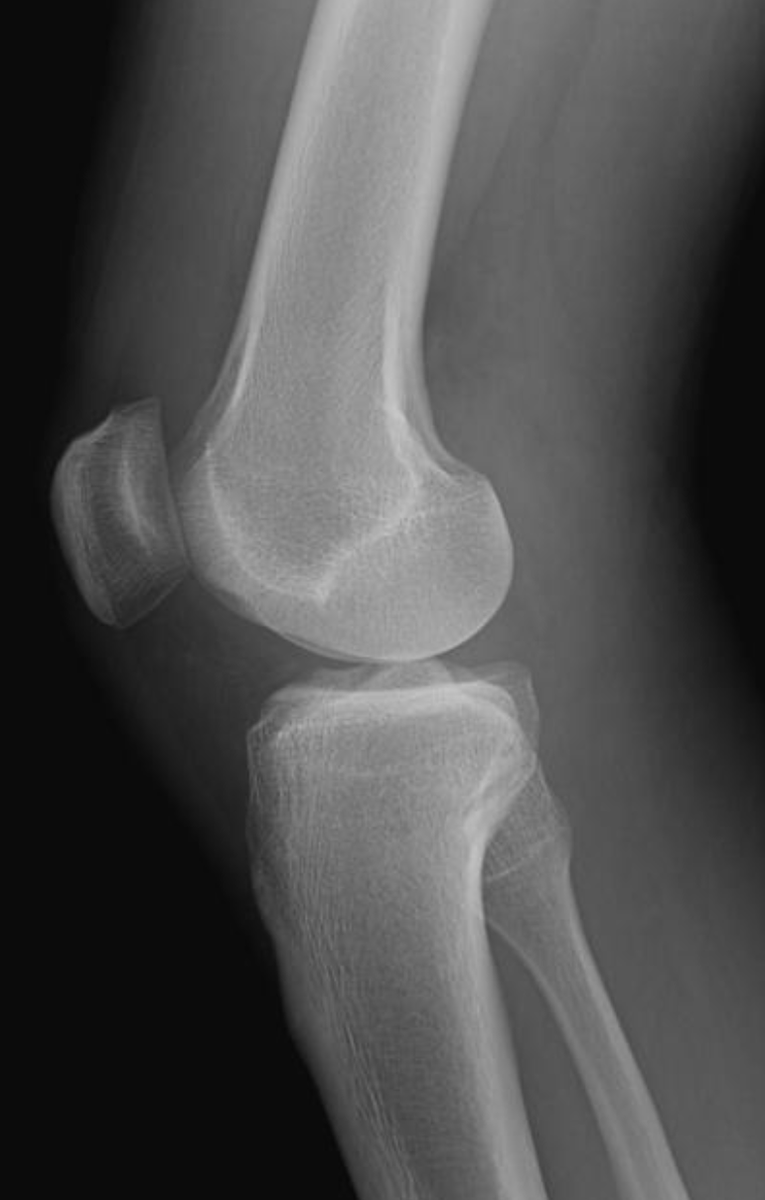 Shingo_Omata's tweet photo. <What’s your diagnosis?>
Trauma
#Rdiag #RadEd #MedEd #MSKRad #ERrad #FOAMed #FOAMrad https://t.co/IZUMgDf4iX