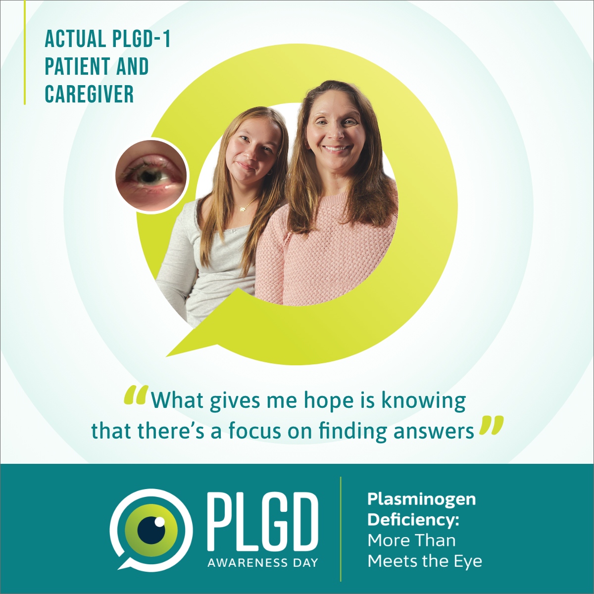 👀 Chronic Conjunctivitis? It Could Be PLGD-1.👀

Kedrion Biopharma is recognizing Plasminogen Deficiency Awareness Day on May 5th. Plasminogen Deficiency Type 1 (PLGD-1) is a rare genetic disorder that causes ligneous lesions to form throughout the body. Ligneous conjunctivitis