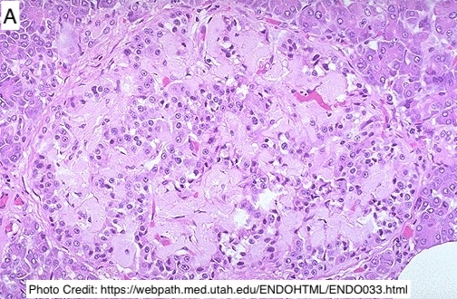 Path4People's tweet image. Which Islet of Langerhans would you see in someone with Diabetes Mellitus Type I v. Type II?
🤔 

#pathx #endocrine #fammed #medstudent #pathology