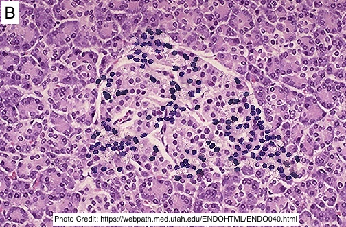 Path4People's tweet image. Which Islet of Langerhans would you see in someone with Diabetes Mellitus Type I v. Type II?
🤔 

#pathx #endocrine #fammed #medstudent #pathology