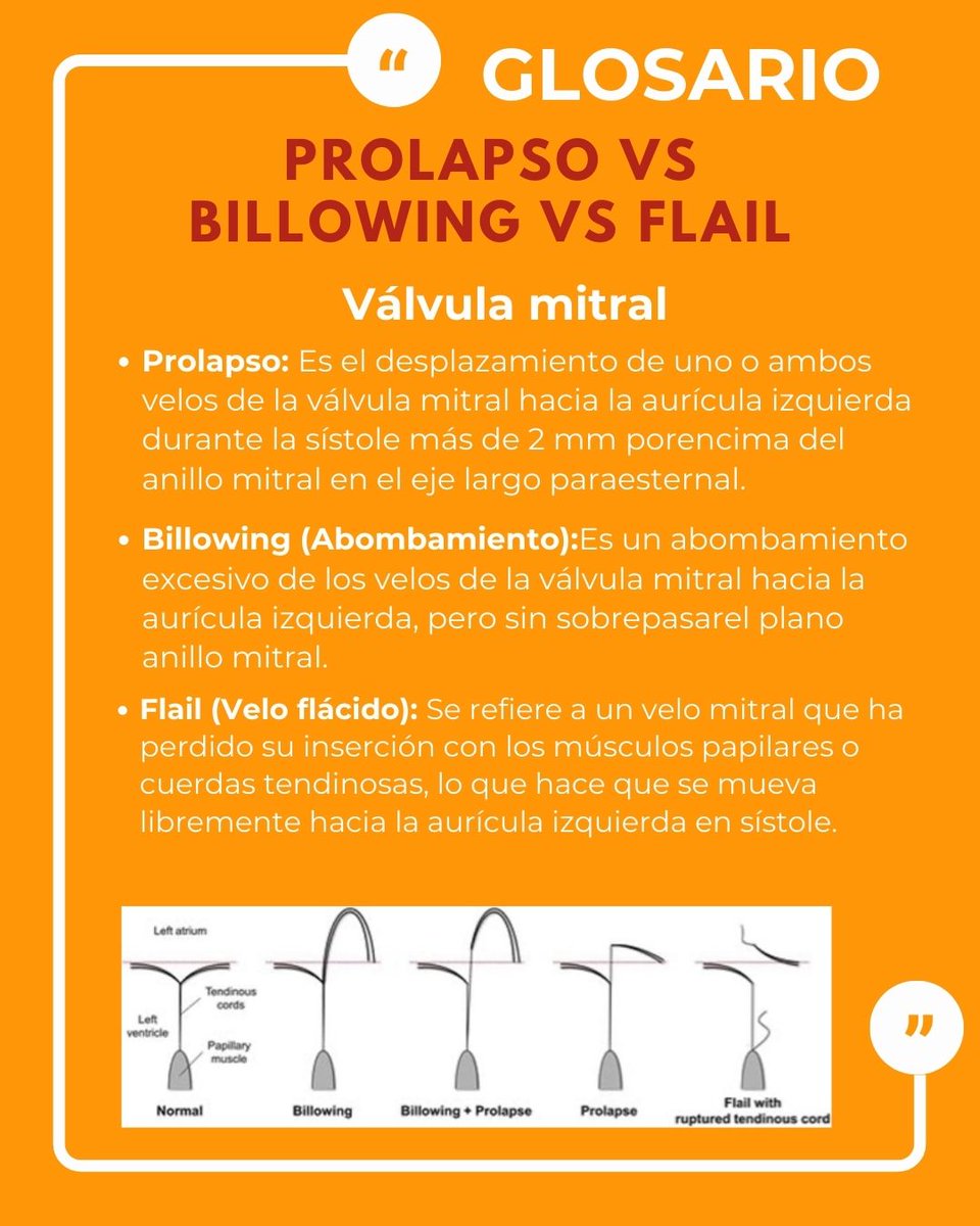 Prolapso vs. Billowing vs. Flail – Válvula mitral
Prolapso: Desplazamiento de los velos &gt;2 mm sobre el anillo mitral en sístole
Billowing: Abombamiento de los velos sin sobrepasar el anillo mitral
Flail: Velo libre que perdió su inserción y se mueve sin control hacia la aurícula