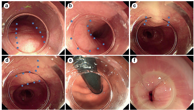 J. Sebastián P. A. (@jsebastianpa) on Twitter photo 💡Important luminal landmarks in POEM.
a=spine
b=aortic arch
c=trachea
d=left main bronchus
e=GEJ in retroflexion
f=GEJ in forward view.
📗<a href="/NatRevGastroHep/">Nature Reviews Gastroenterology & Hepatology</a>
<a href="/RobertBechara/">Robert Bechara</a> 💡Important luminal landmarks in POEM.
a=spine
b=aortic arch
c=trachea
d=left main bronchus
e=GEJ in retroflexion
f=GEJ in forward view.
📗<a href="/NatRevGastroHep/">Nature Reviews Gastroenterology & Hepatology</a>
<a href="/RobertBechara/">Robert Bechara</a>