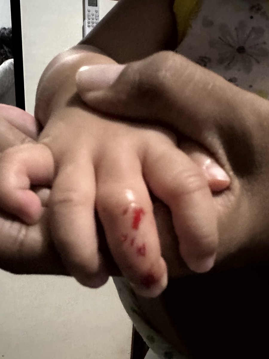 kleyripiko's tweet photo. Maiyak iyak ako kagabi nung nakikita ko yan. I feel so sorry for my baby that she has that lots of wound. Naabot niya kasi ang e-fan namin. At wala man lang nakapigil. It was too late na. But she's doing okay na ngayon. https://t.co/t4ayABXBIq