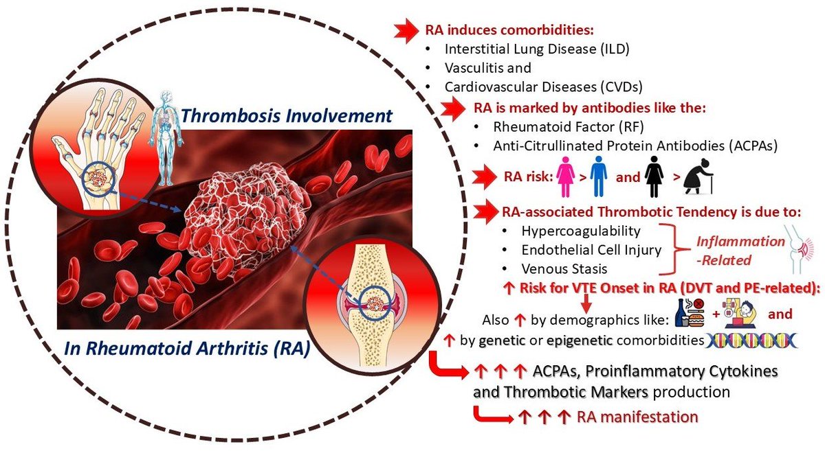 CIMB MDPI (@cimb_mdpi) on Twitter photo 🧬💥 Rheumatoid arthritis isn’t just about aching joints-it's a ticking thrombotic time bomb! Chronic inflammation fuels clot formation🩸Discover how targeting shared pathways may revolutionize treatment for both RA & thrombosis!
More : mdpi.com/1467-3045/47/4…
<a href="/MDPIBiologySubj/">MDPI Biology</a> 🧬💥 Rheumatoid arthritis isn’t just about aching joints-it's a ticking thrombotic time bomb! Chronic inflammation fuels clot formation🩸Discover how targeting shared pathways may revolutionize treatment for both RA & thrombosis!
More : mdpi.com/1467-3045/47/4…
<a href="/MDPIBiologySubj/">MDPI Biology</a>