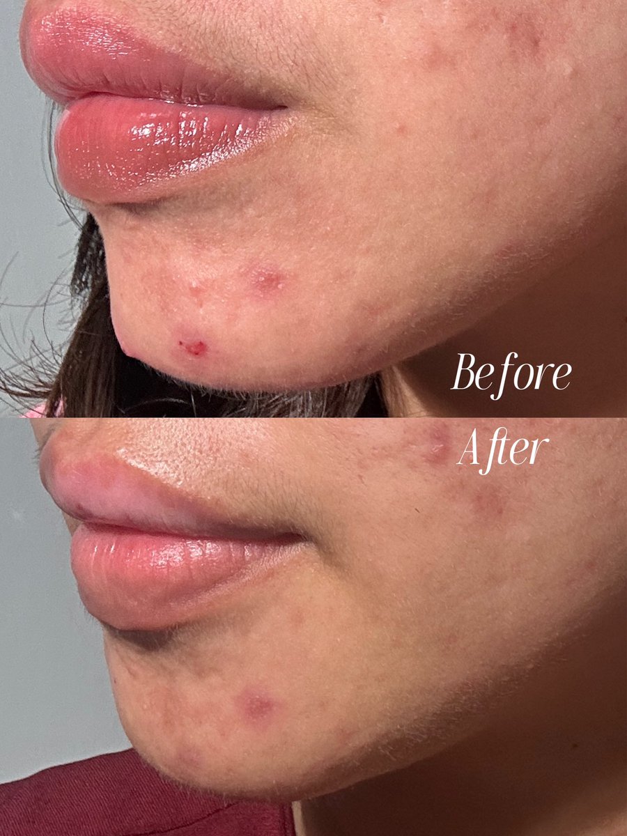 la_lalijah's tweet photo. Udah lama pake dark spot serum ini dan hasilnya ga pernah gagal!😩🤍

Ini ga perih di kulit ya, jadi aman untuk kulit sensitif kaya aku🤗✔️ https://t.co/RV4RxHUegu