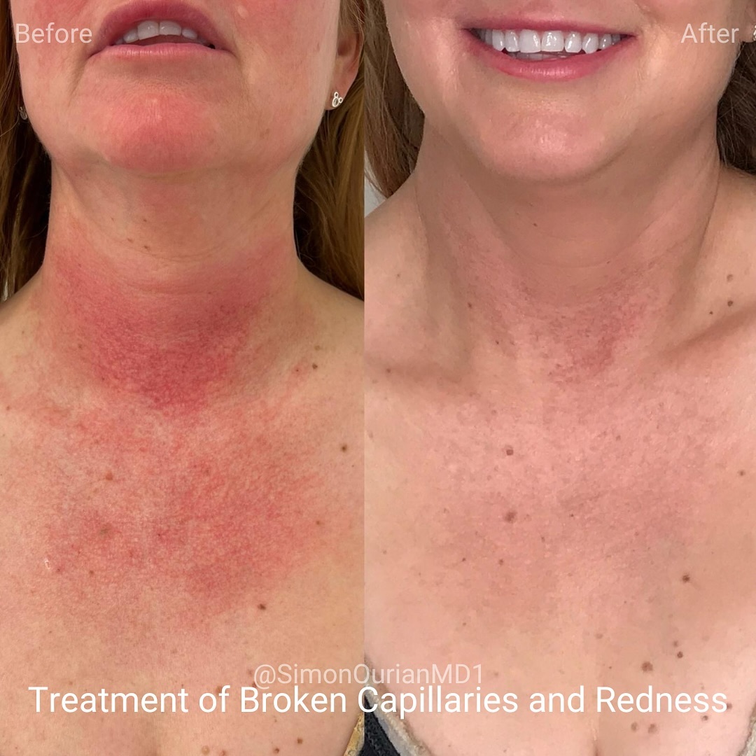 simonourianmd's tweet image. Here are progress photos from just one session of blue light therapy to reduce broken capillaries and redness on the neck and chest.

#bluelight #beauty #simonourian #epionebeverlyhills