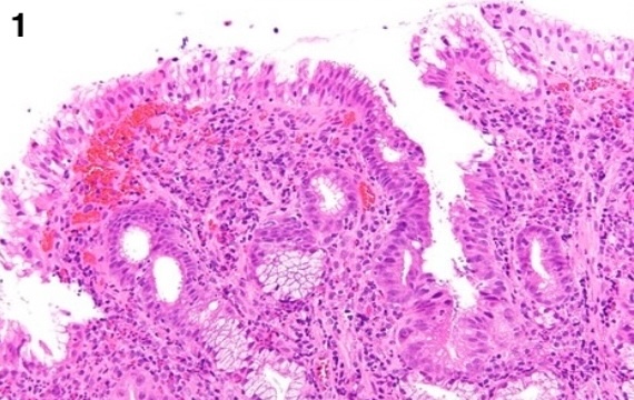 Anarkhuu's tweet photo. Stomach biopsy, which one is cancer (case 1 or 2)?
#GIpath #PathX #PathTwitter https://t.co/y7os2dCBi9