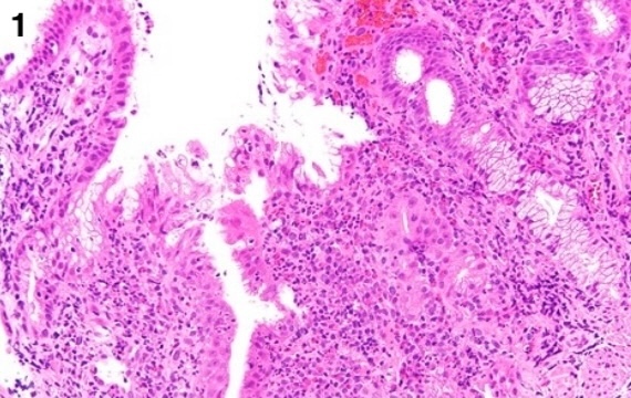 Anarkhuu's tweet photo. Stomach biopsy, which one is cancer (case 1 or 2)?
#GIpath #PathX #PathTwitter https://t.co/y7os2dCBi9