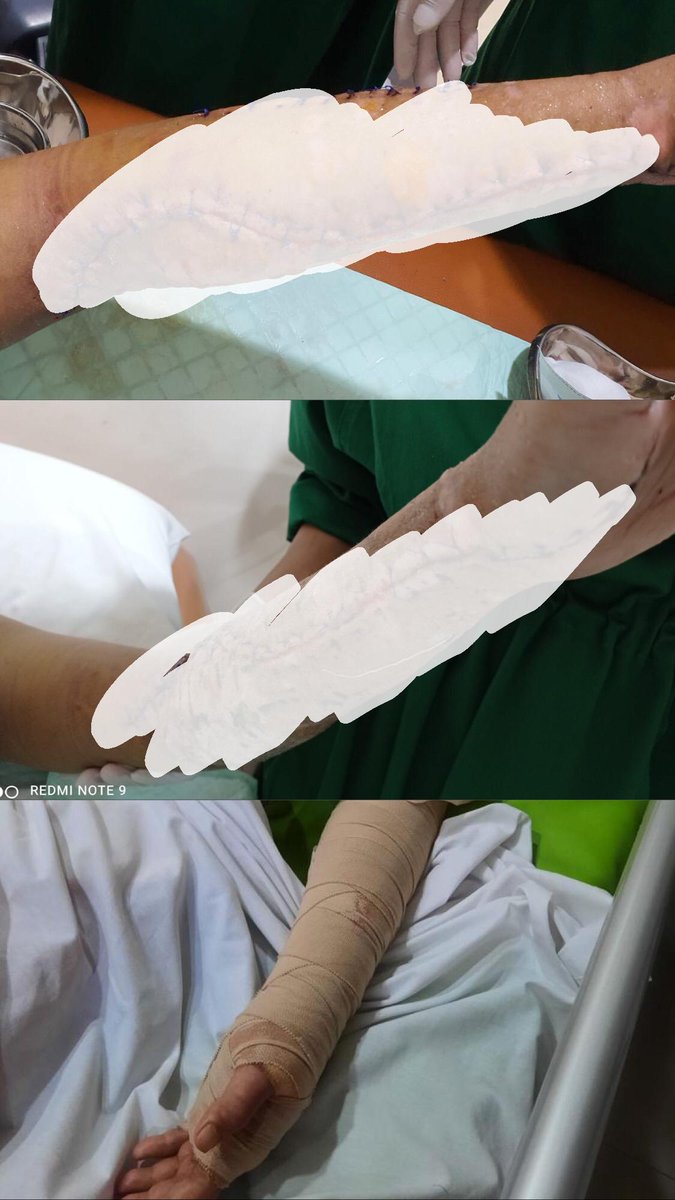 F4rizfirmansyah's tweet photo. TEMAN2 TOLONG BANTU VIRALKAN KASUS INI‼️ SAYA KORBAN DUGAAN MALPRAKTIK, RS TERKENAL KOTA BEKASI BUAT TANGAN SAYA CACAT!

Dirawat karena DBD, riwayat disuntik berulang di tempat yang sama. masih juga dibilang “risiko medis” ???
Sudah 3 tahun saya berjuang, tapi belum ada keadilan. https://t.co/5TBNI0wyjY
