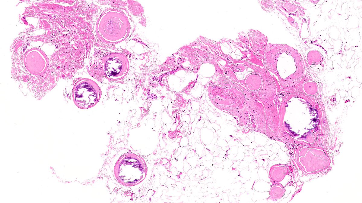 What’s the diagnosis of this breast lesion associated with microcalcifications? 🔬

Poll in the comments 👇

Answer to be posted on Monday

#PathX #PathTwitter #breastpath #PathQuiz