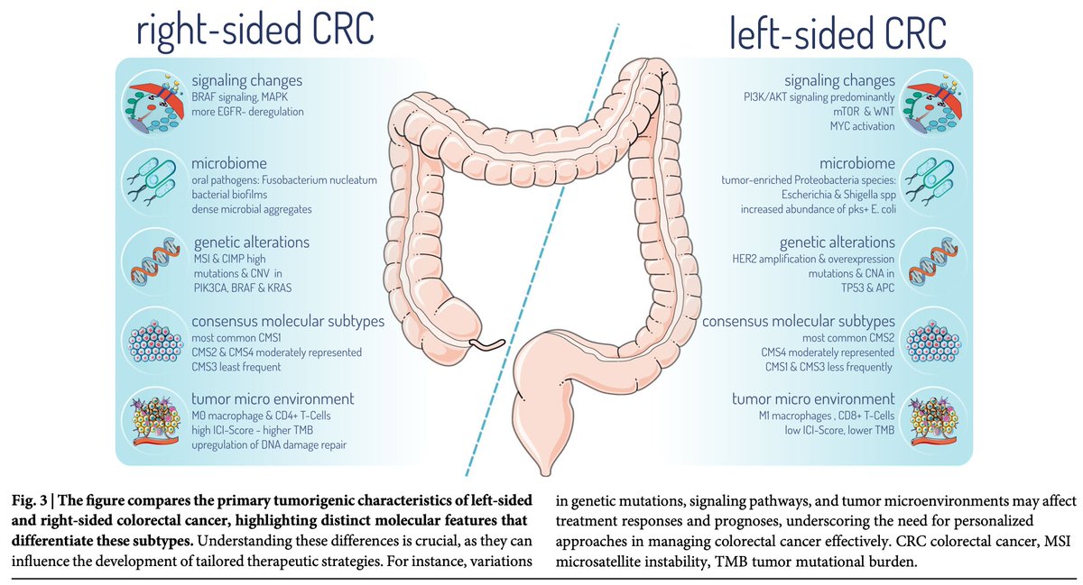 drtahuahua's tweet photo. Multidimensional differences in Right vs Left sided Colorectal Ca

R &amp; L CRC differ in tumor biology, clinical behavior &amp; response to targeted therapy

Shifting from sidedness to molecular classification may better guide treatment decisions @OncoAlert 
https://t.co/jf7fTbybPg https://t.co/w6HvujX3NH