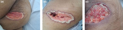 Read up on this rare case of aggressive pyoderma gangrenosum with Cogan syndrome in a person with skin of colour doi.org/10.1093/skinhd… #SHD