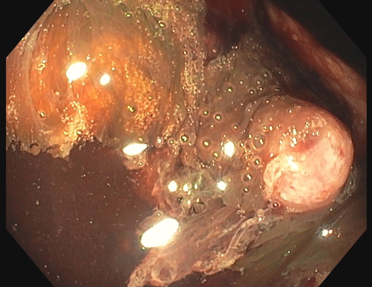 75-year old man, emergent egds due to hematemesis and black stool. Hb 68 g/L, 150/95 mmHg, 84/min pulse. COPD, atrial fib. 

Giant ulcer in the proximal fundus was found with large vessel. Images are from the second egds after erythromycin. 

What do you do?