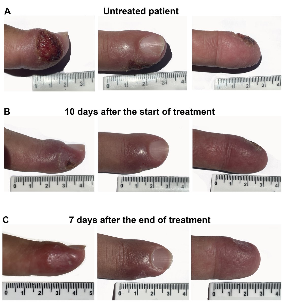 OliveiraFMS's tweet photo. Let's talk about workplace accidents. "A case of cutaneous leishmaniasis by a needlestick injury: an occupational infection or “experimental infection”?" https://t.co/BC1BilFw6I
#Parasite  #Pathology #Research https://t.co/pMZDG9z0Bq