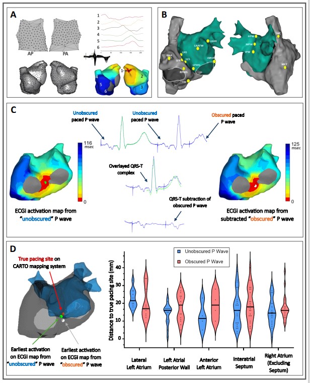 CircEP (@circulationep) on Twitter photo QRS-T subtraction algorithm in #ECGi mapping can regionalize triggers during #AF ablation even if pwaves are obscured <a href="/PennEPFellows/">Penn Electrophysiology Fellowship</a> <a href="/PennCardiology/">Penn Cardiology</a> <a href="/AlirezaOraii/">Alireza Oraii</a> #AHAJournals #Epeeps doi.org/10.1161/CIRCEP… QRS-T subtraction algorithm in #ECGi mapping can regionalize triggers during #AF ablation even if pwaves are obscured <a href="/PennEPFellows/">Penn Electrophysiology Fellowship</a> <a href="/PennCardiology/">Penn Cardiology</a> <a href="/AlirezaOraii/">Alireza Oraii</a> #AHAJournals #Epeeps doi.org/10.1161/CIRCEP…