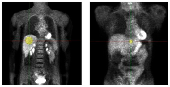 Tomography_MDPI's tweet image. 🔬 New study alert!
Can lower tracer doses in [18F]-FDG PET still deliver reliable texture features?
📊 Phantom + patient analysis shows the impact on image quality.
👉 #PETimaging #Radiology #DoseReduction
📖 brnw.ch/21wSdBw